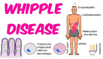 whipple disease