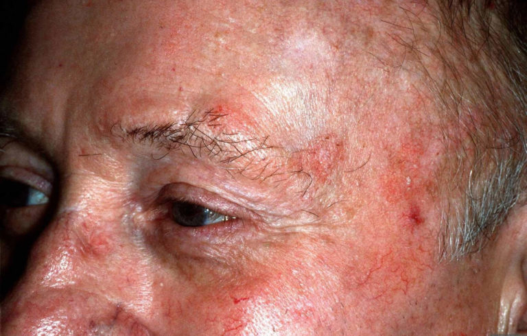 Seborrheic Keratosis - Causes, Symptoms, Home Treatment