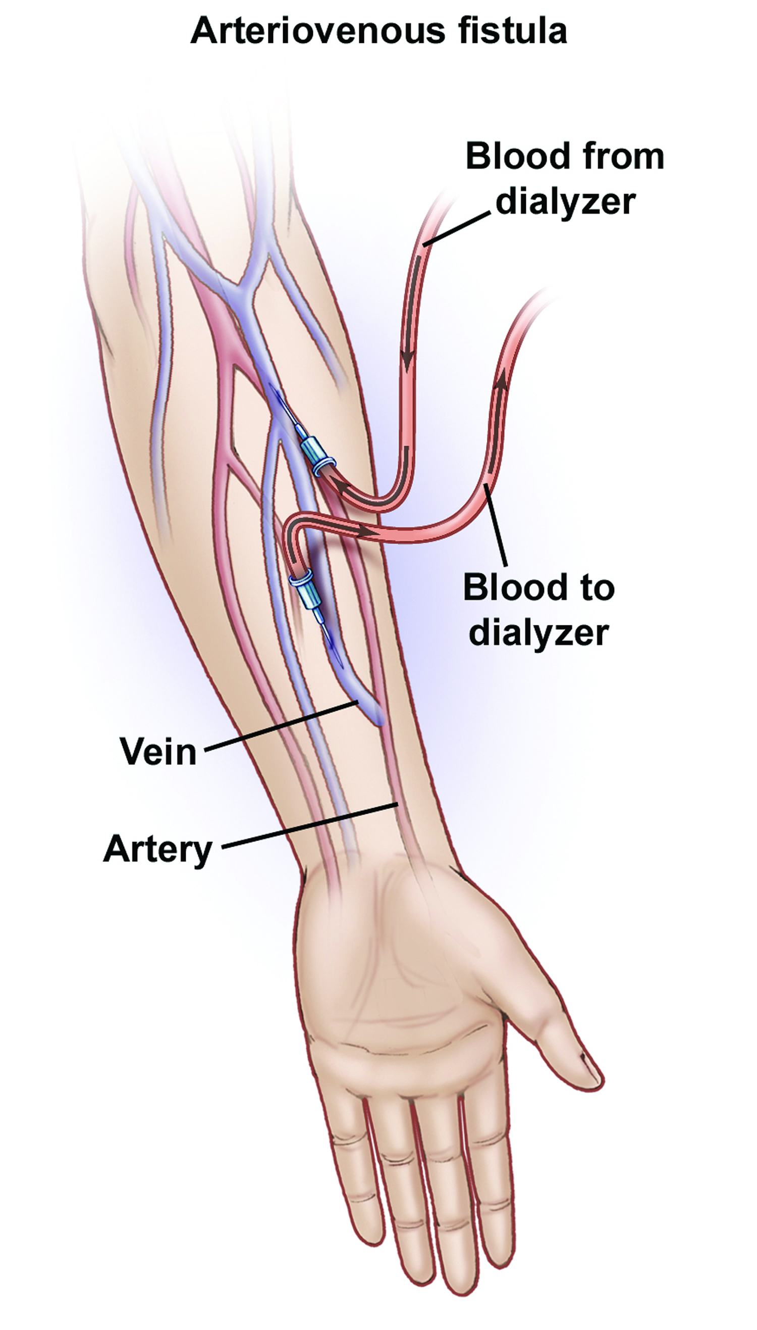 Arteriovenous Fistula For Dialysis Dural Symptoms