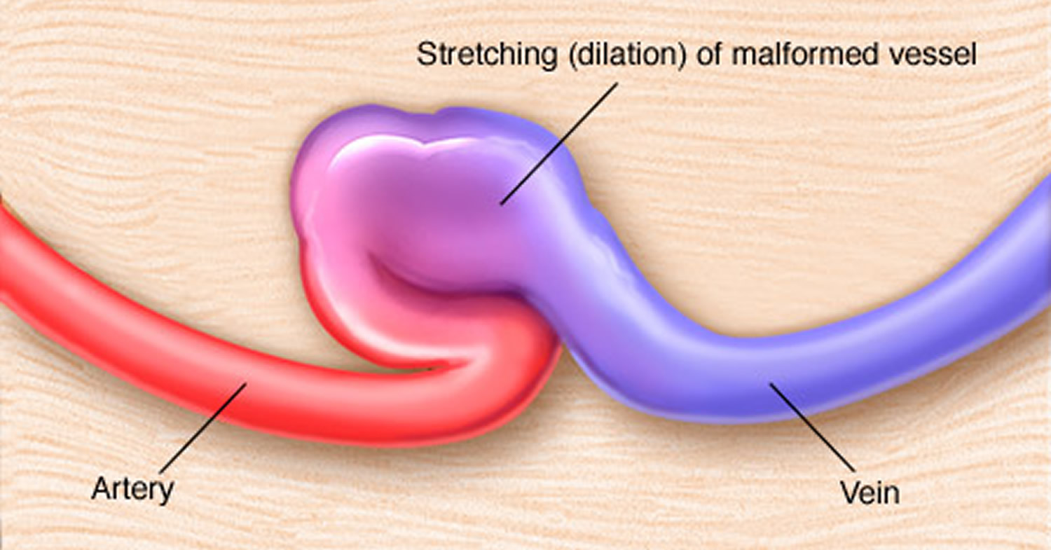 Arteriovenous Fistula For Dialysis Dural Symptoms