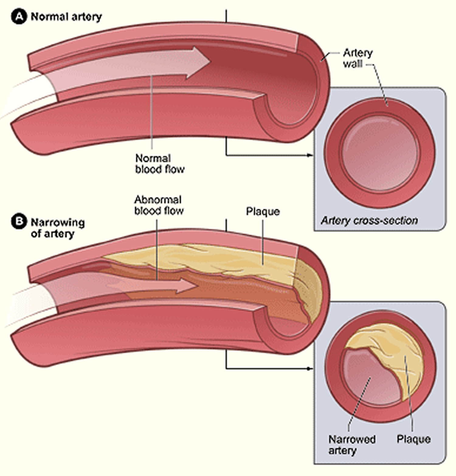 Atherosclerosis Causes Risk Factors Symptoms Diagnosis Treatment