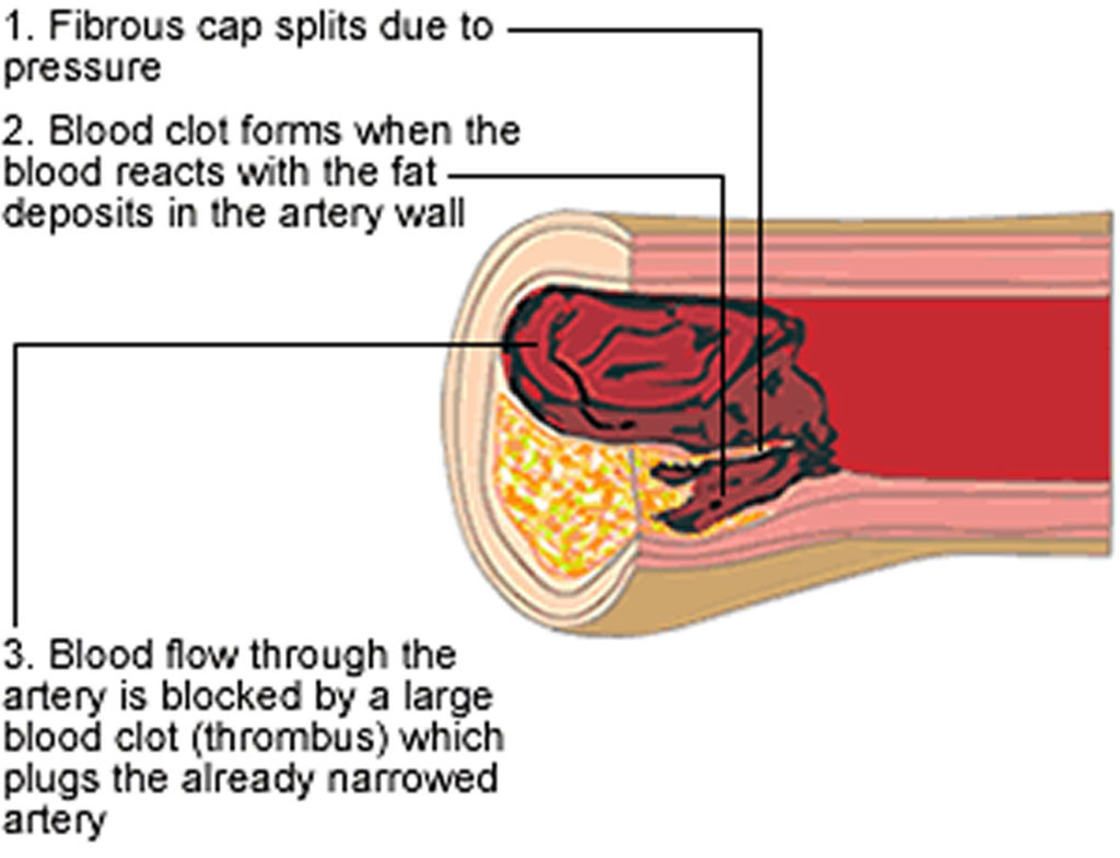 Atherosclerosis Symptoms Risk Factors And Health Comp - vrogue.co