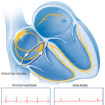 Atrial flutter