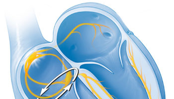 Atrial flutter