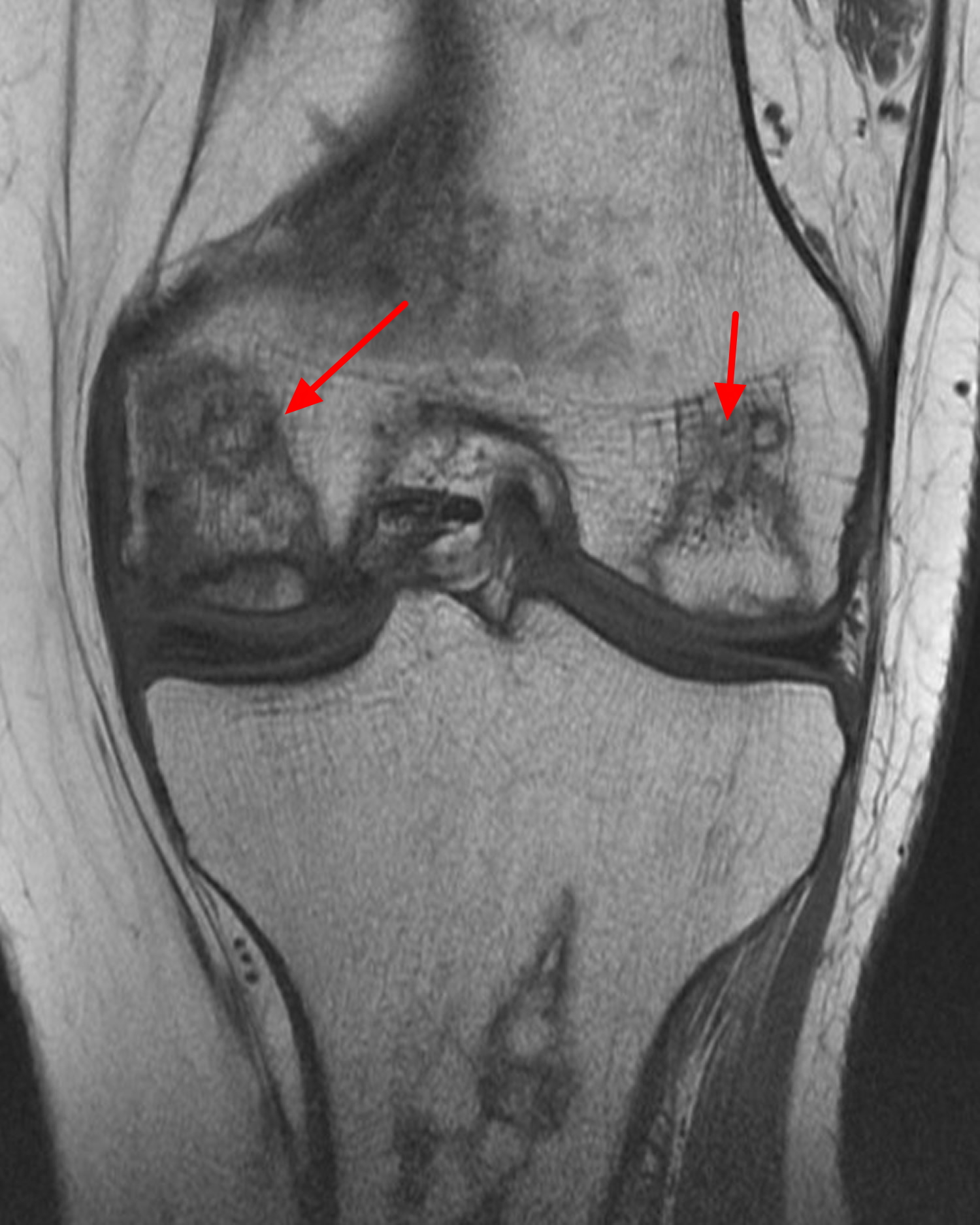 Avascular Necrosis Causes Symptoms Prevention And Treatment