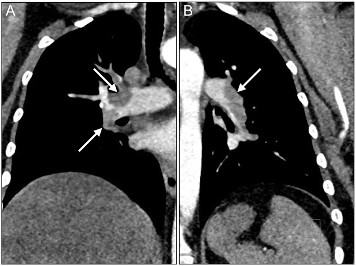 Bilateral Pulmonary Embolism 