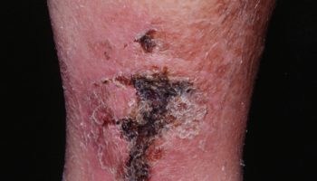 Calciphylaxis wounds