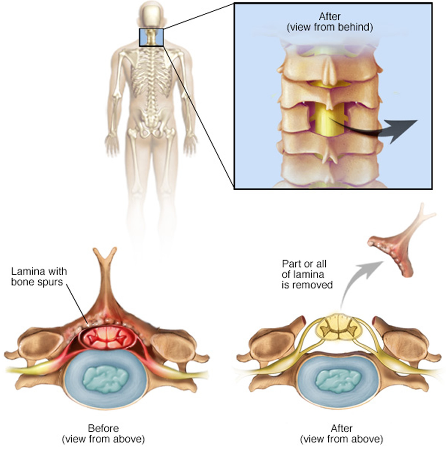 laminectomy