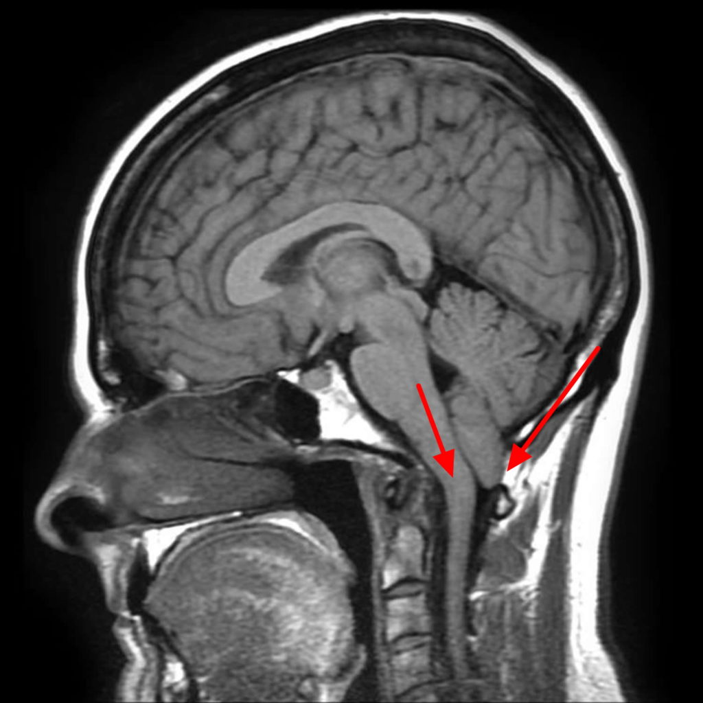 Chiari Malformation - Causes, Symptoms, Prognosis, Diagnosis, Treatment