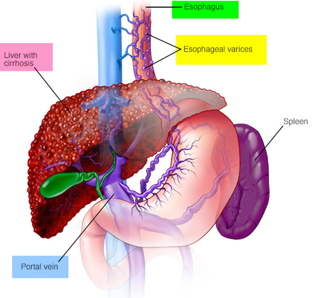 Risks Of Banding Esophageal Varices