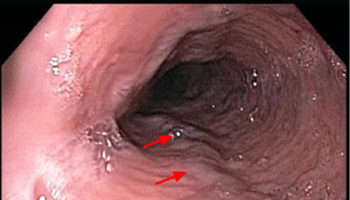 esophageal varices