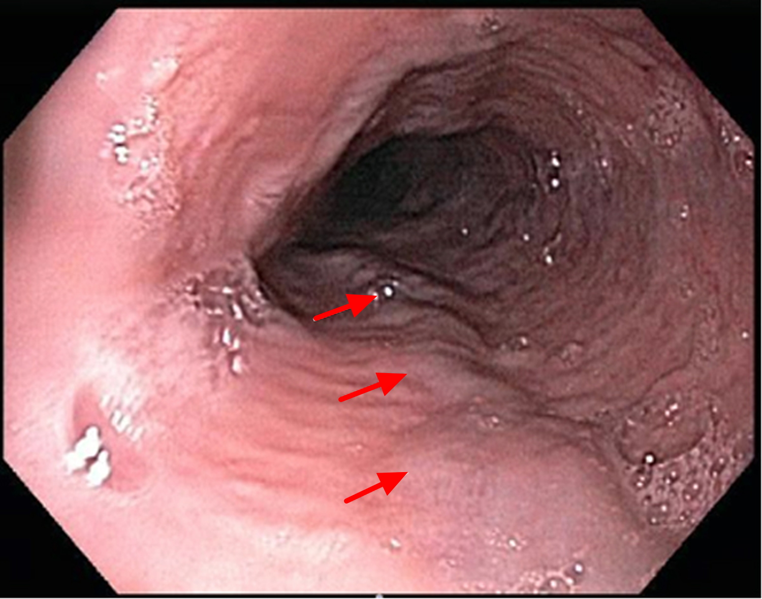 esophageal varices rupture