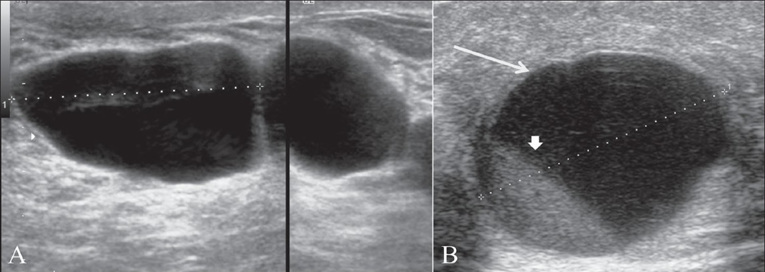 fibrocystic breast changes and brest cancer