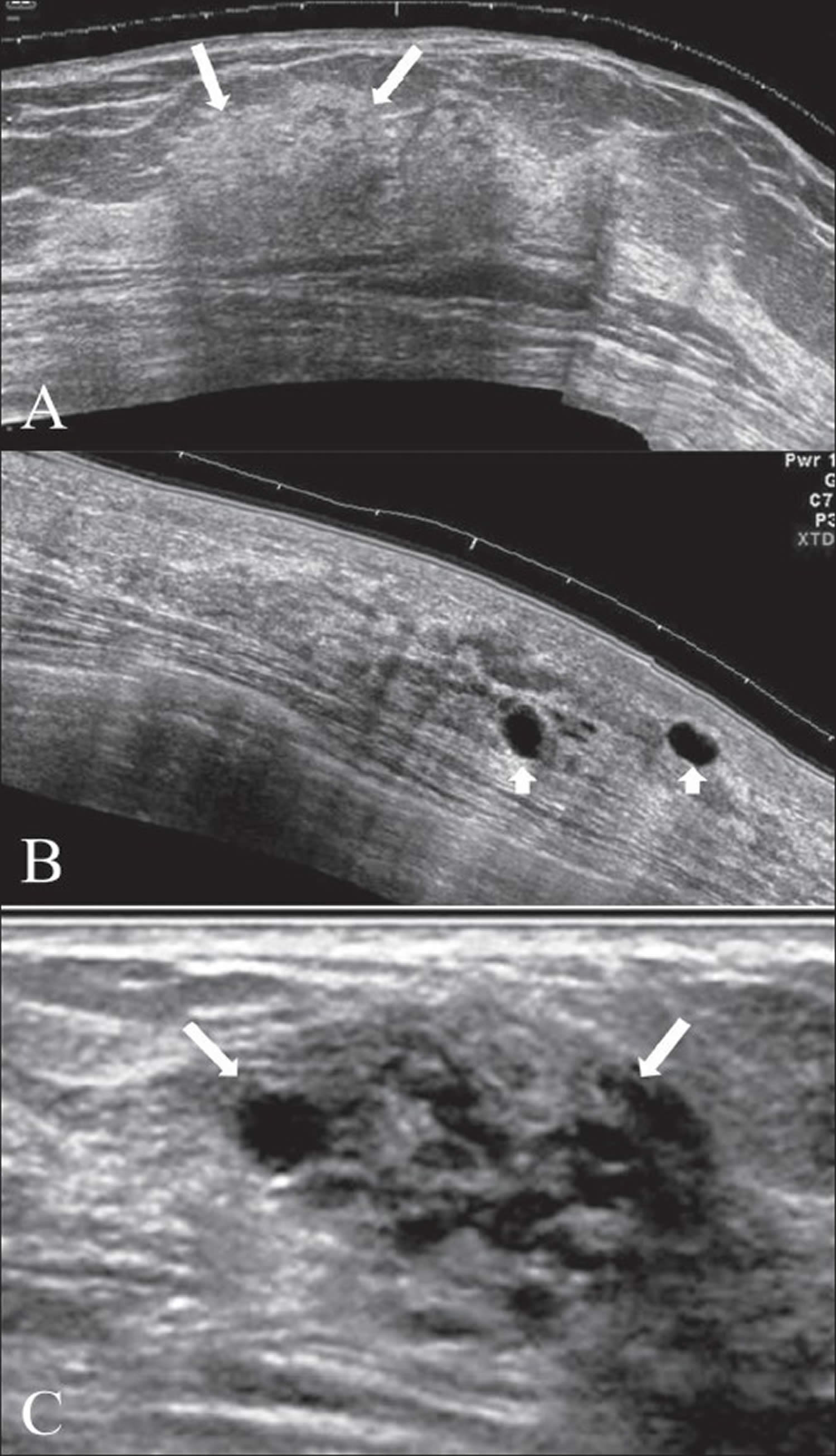 fibrocystic breast changes lumps that are normal