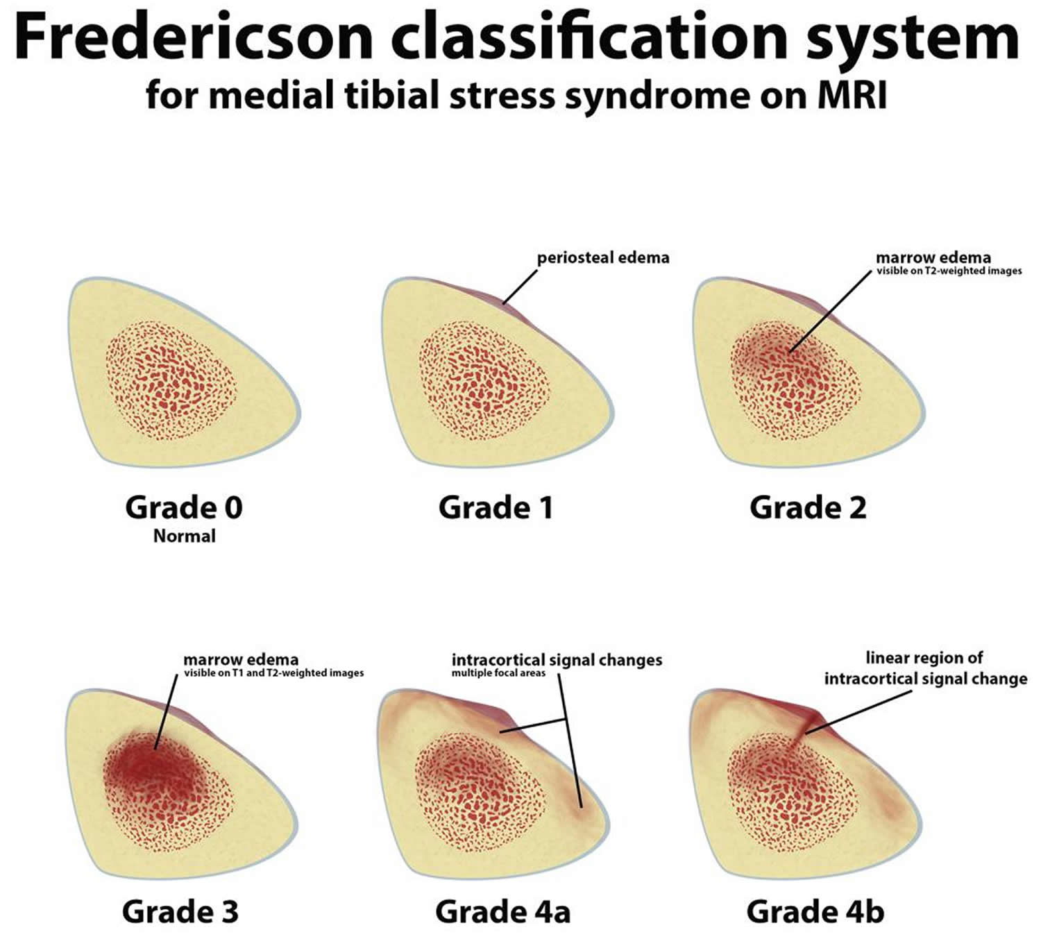 Fredericson shin splints classification