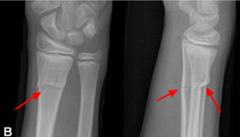 Greenstick fracture