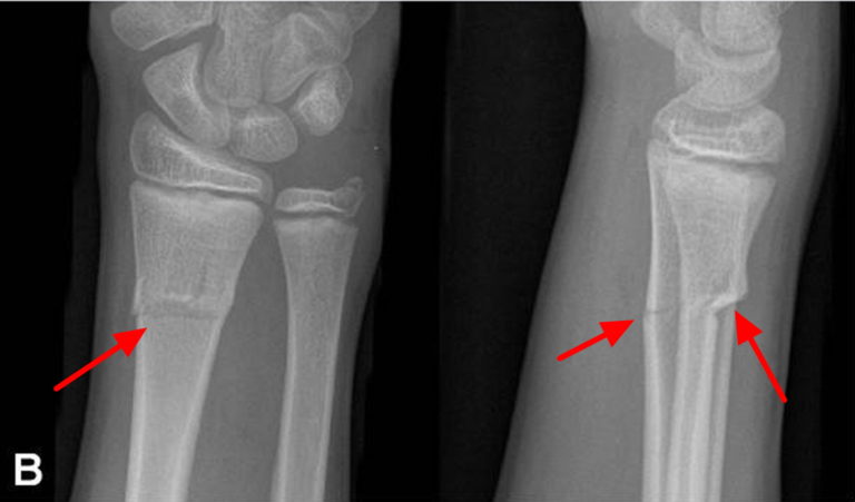 buckle fracture wrist in adults