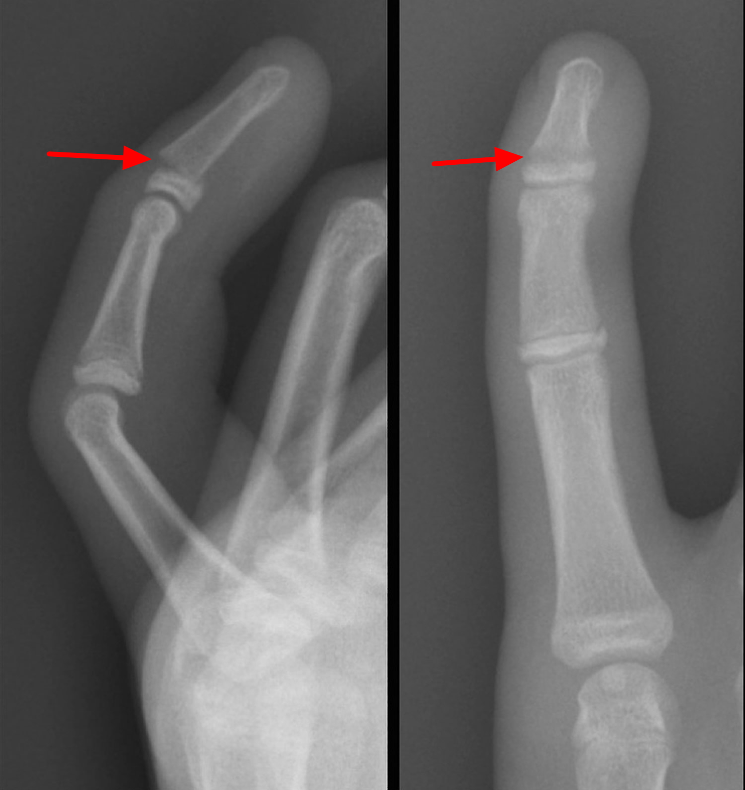 Трещина фаланги. Перелом фаланги мизинца рентгенограмма. Перелом ногтевой фаланги 1 пальца. Перелом средней фаланги мизинца. Рентген перелома средней, фаланги мизинца руки.