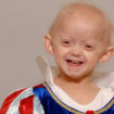 Hutchinson-Gilford progeria syndrome