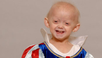 Hutchinson-Gilford progeria syndrome