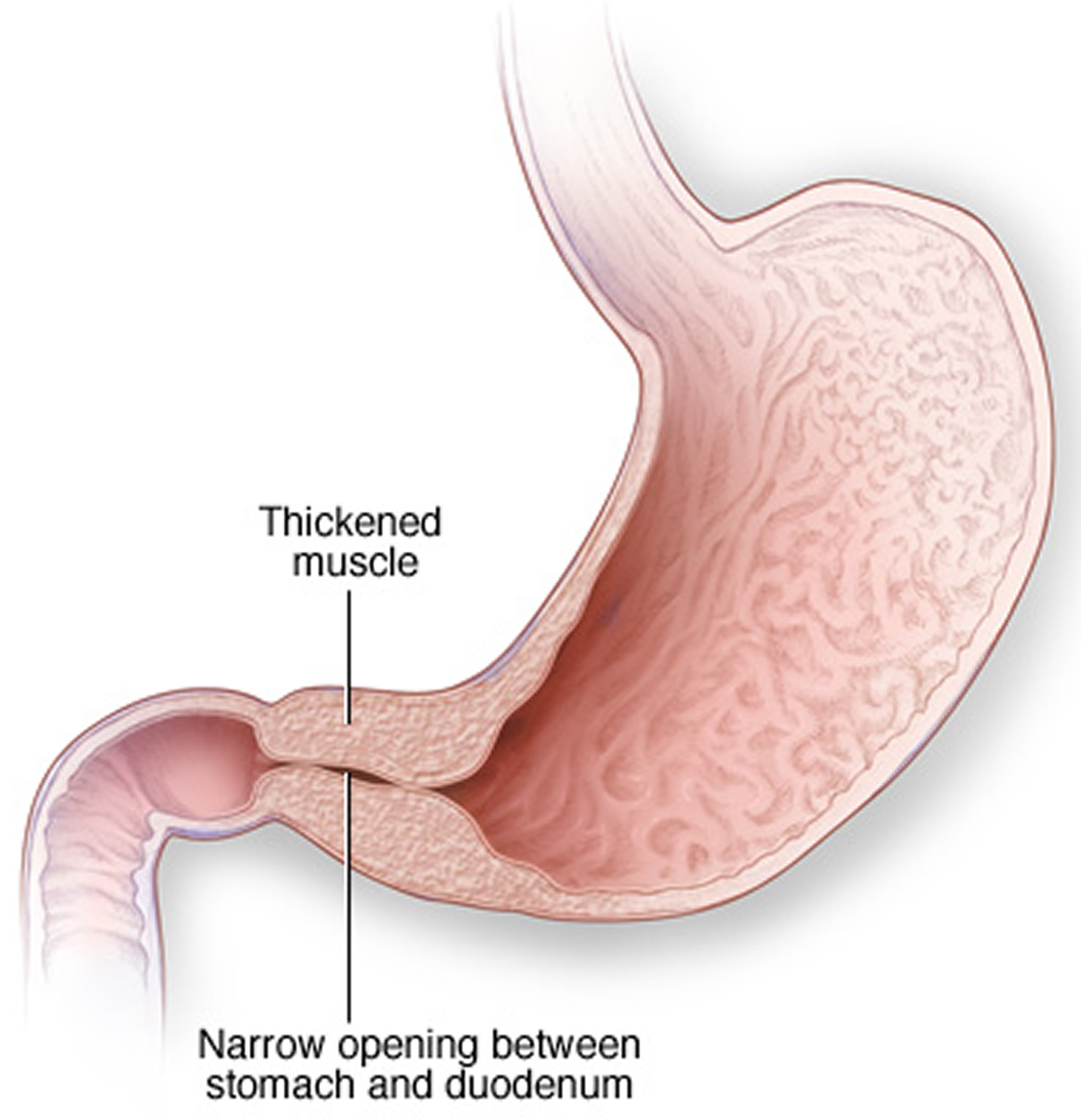 pyloric-stenosis-causes-symptoms-complications-treatment