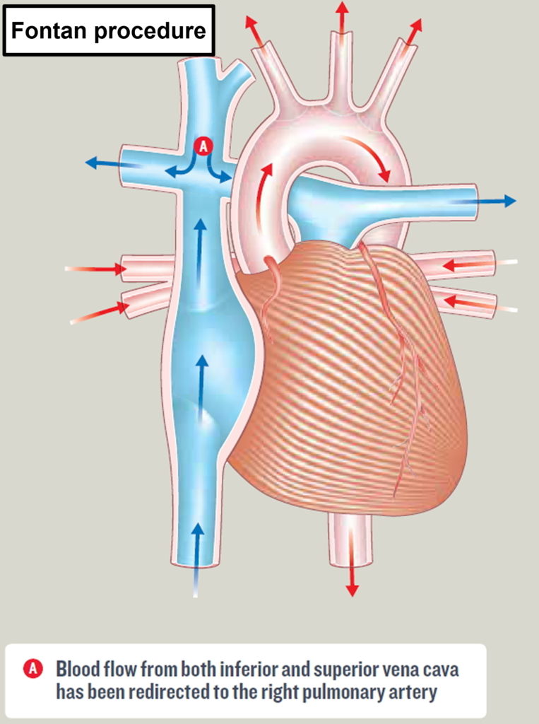 Hypoplastic Left Heart Syndrome - Causes, Prognosis, Surgery, Treatment