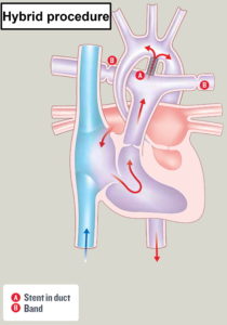 Hypoplastic Left Heart Syndrome - Causes, Prognosis, Surgery, Treatment