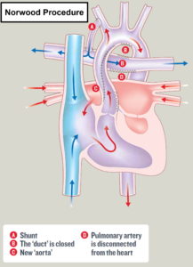 Hypoplastic Left Heart Syndrome - Causes, Prognosis, Surgery, Treatment