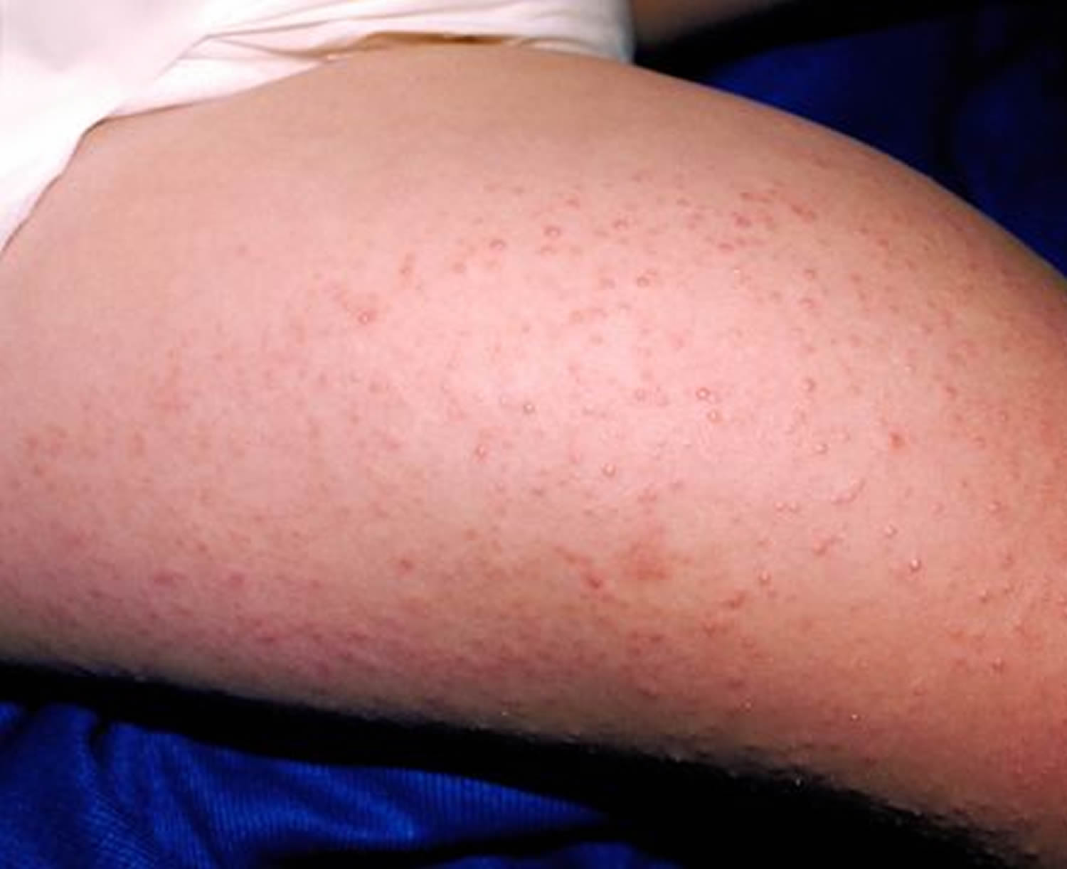 Keratosis Pilaris Causes Symptoms How To Get Rid Of It