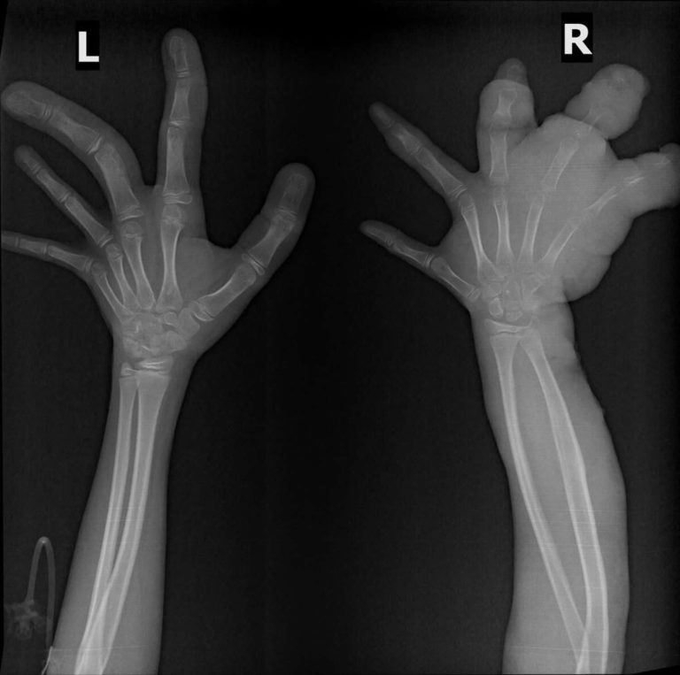 Klippel Trenaunay Syndrome Causes Diagnosis Prognosis Treatment