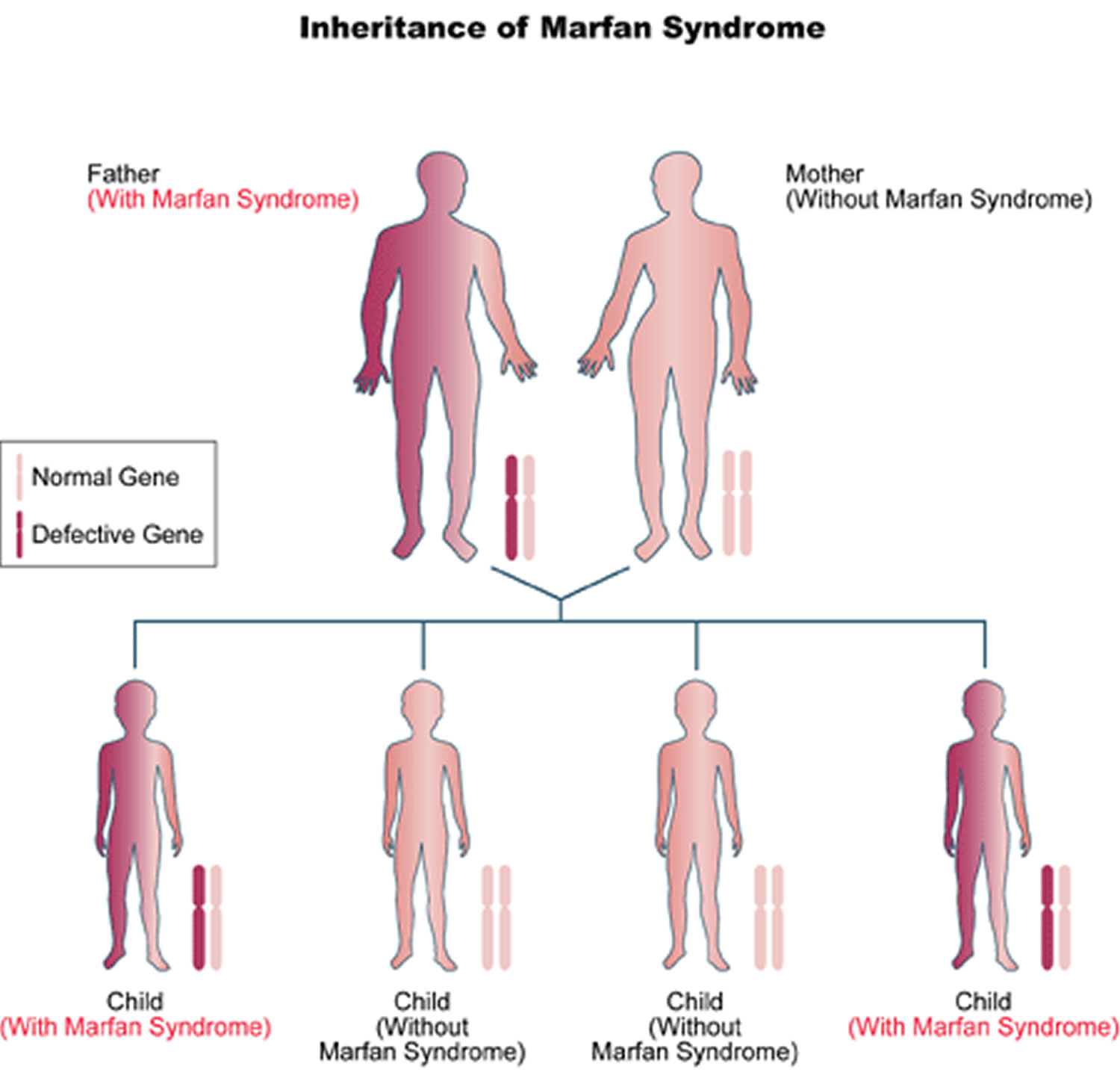 what is marfan syndrome