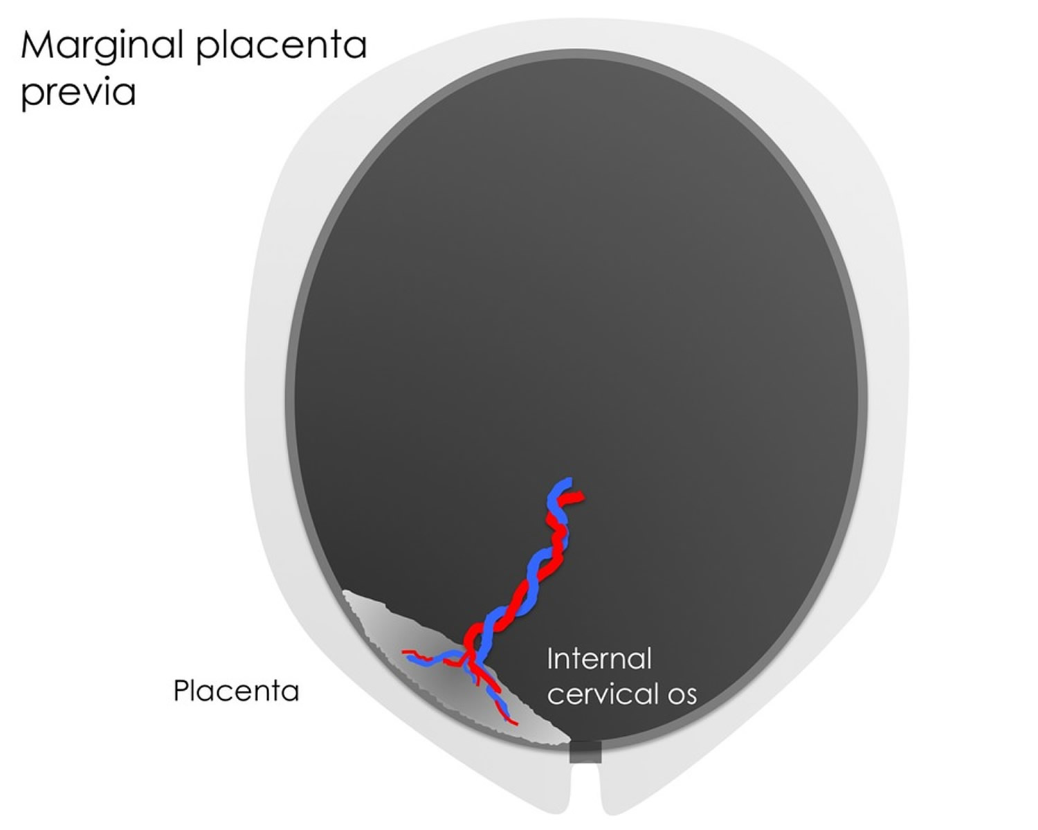 Placenta Previa Causes, Signs, Symptoms, Treatment