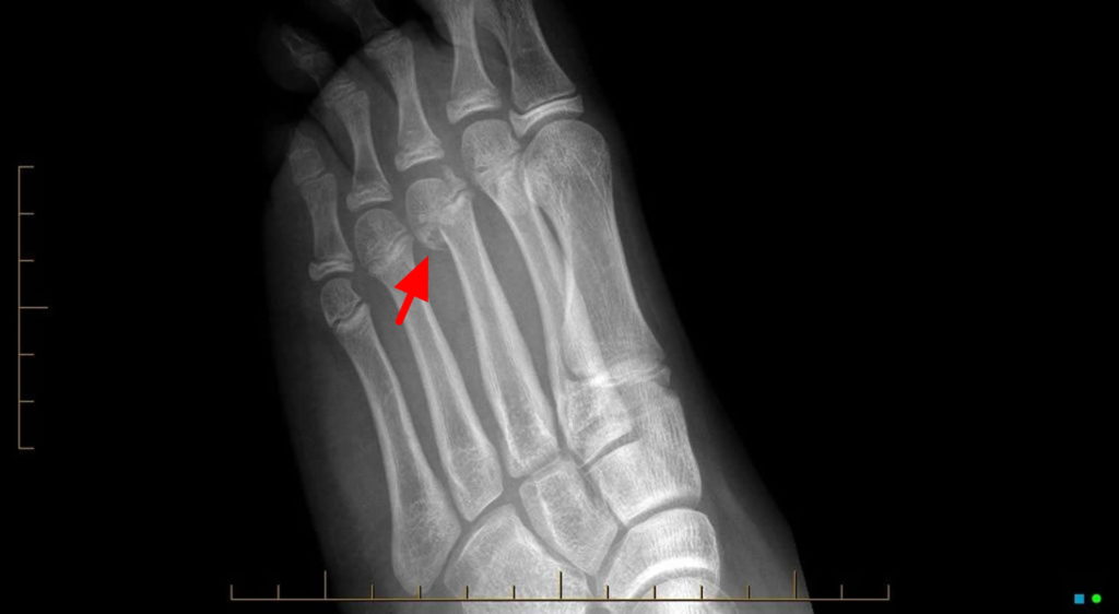 Growth Plate Fracture Causes Types Symptomstreatment 4112