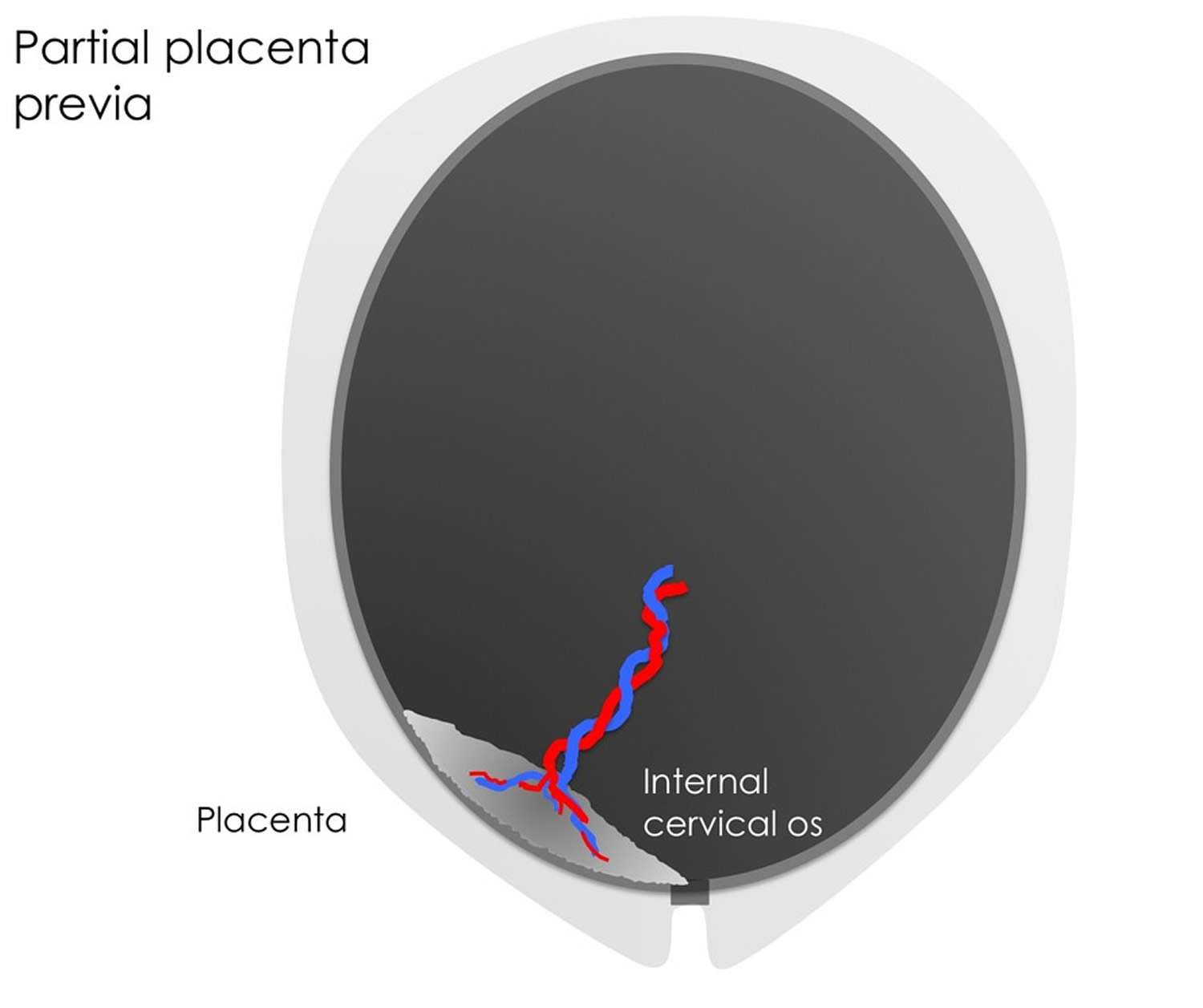 Partial placenta previa