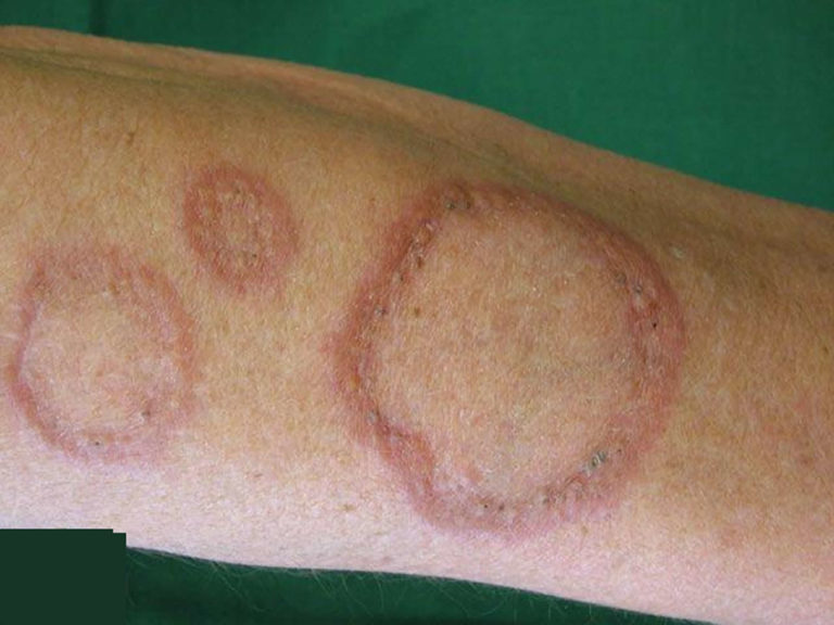 granuloma-annulare-causes-rash-treatment