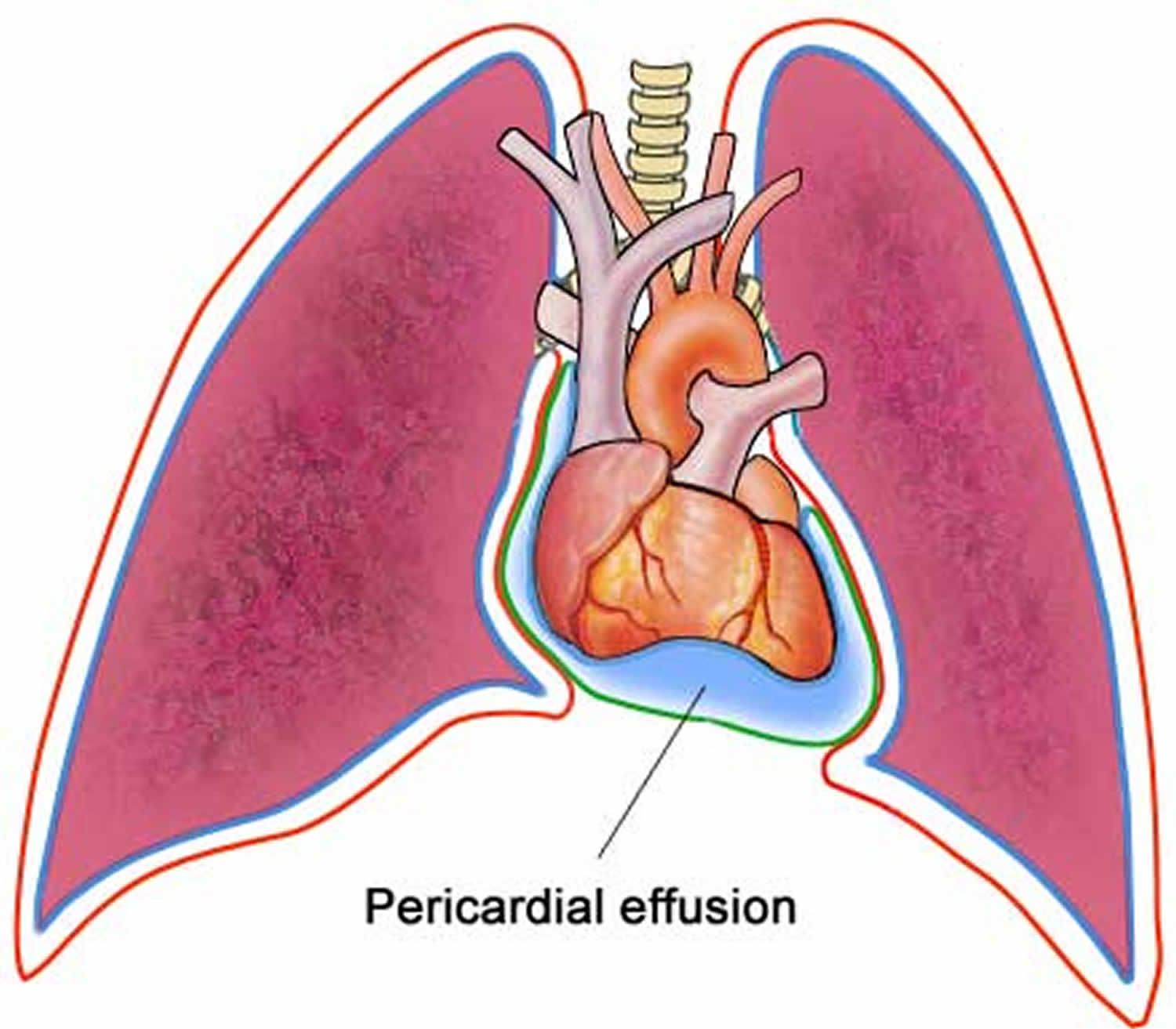 pericardial effusion