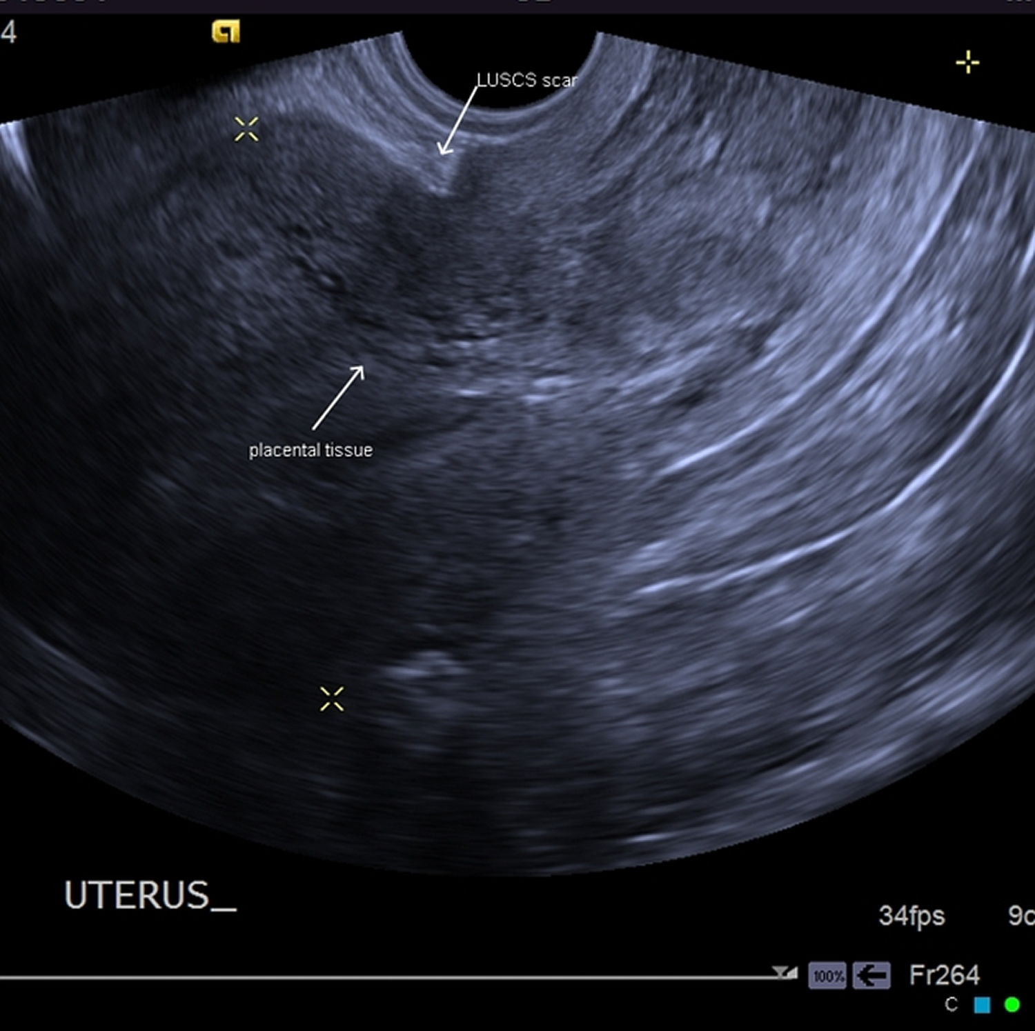 Placenta accreta ultrasound
