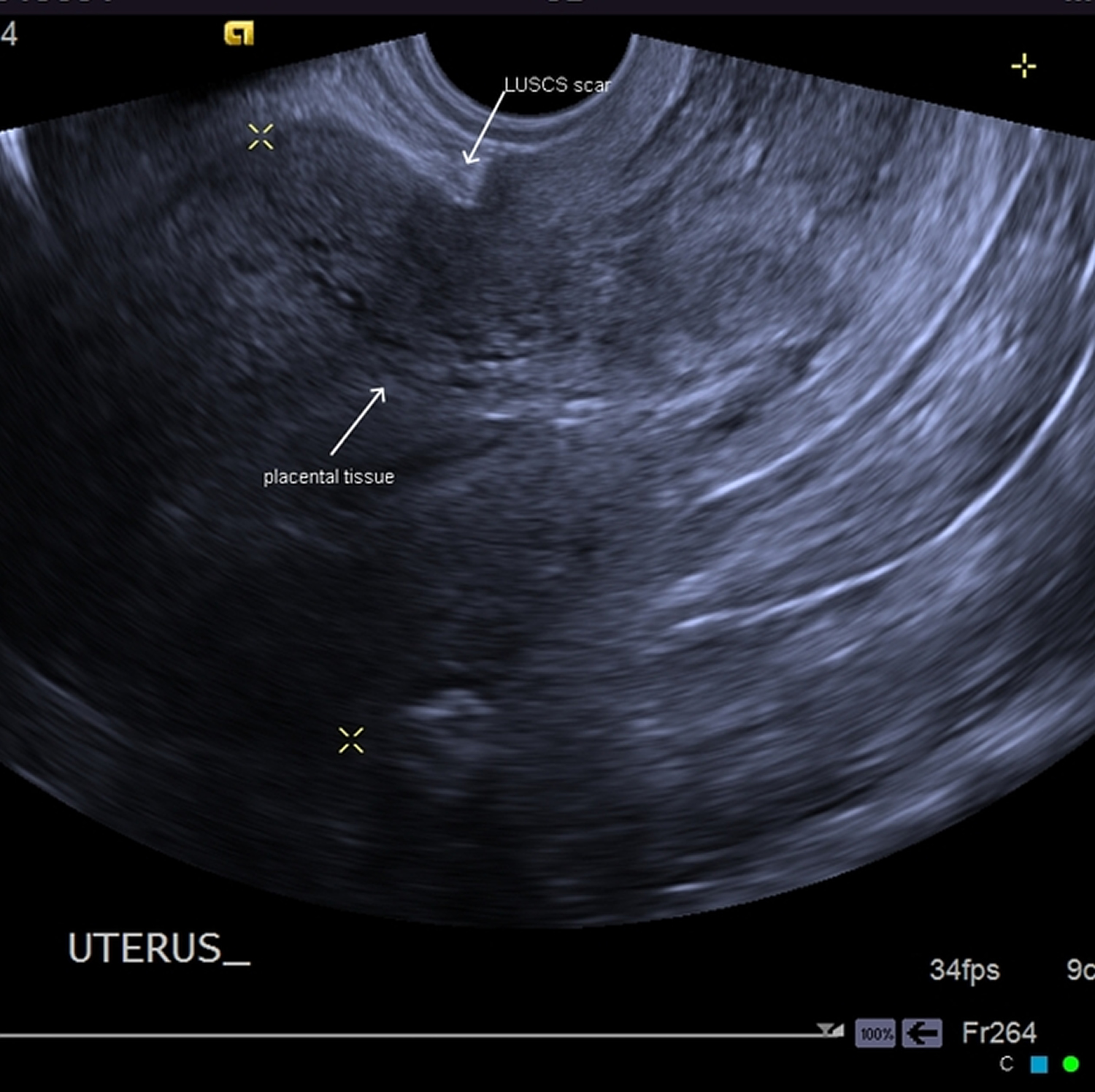 Placenta percreta характеризуется