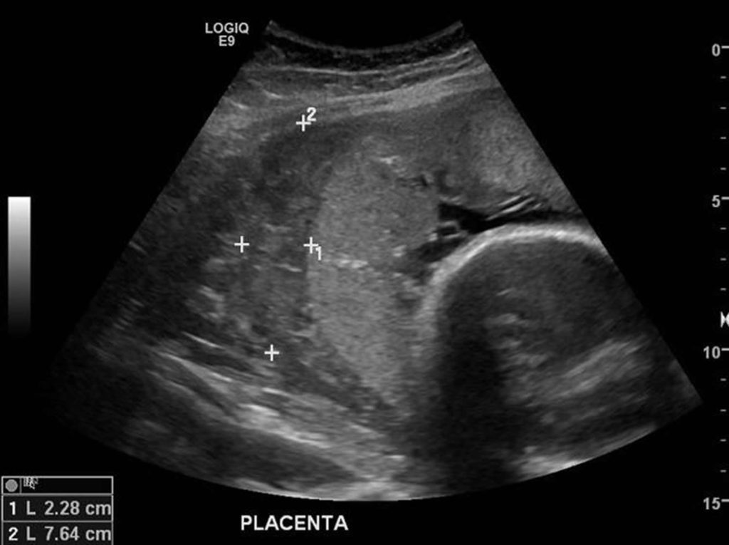 Placental Abruption - Causes, Signs, Symptoms, Treatment