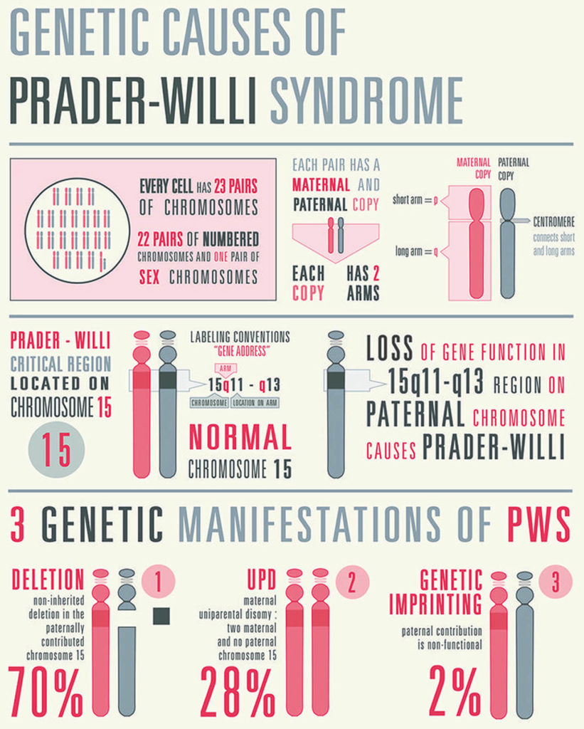 Prader-Willi Syndrome - Cause, Symptoms, Diagnosis, Treatment