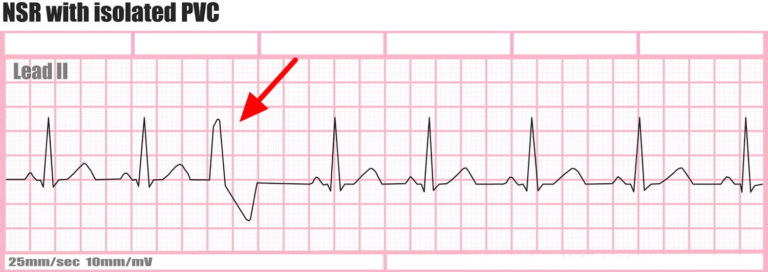 Premature Ventricular Contractions - Causes, Symptoms, Treatment