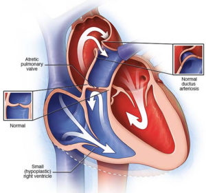 Pulmonary Atresia - Causes, Types, Symptoms, Diagnosis & Treatment