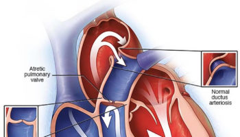 Pulmonary atresia