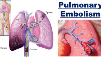 pulmonary embolism