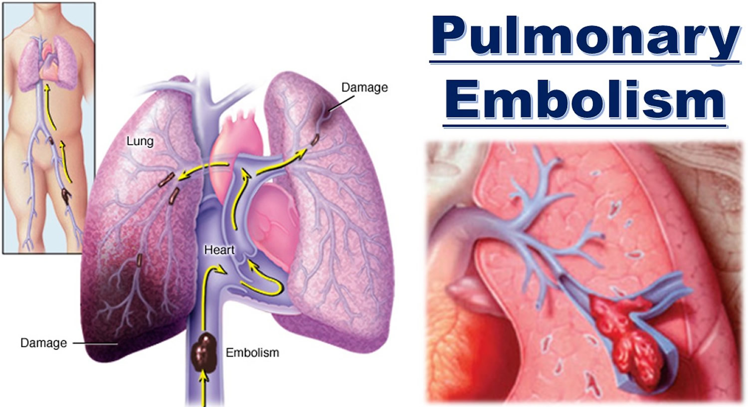 Pulmonary Embolism Causes Signs And Symptoms Diagnosis Treatment