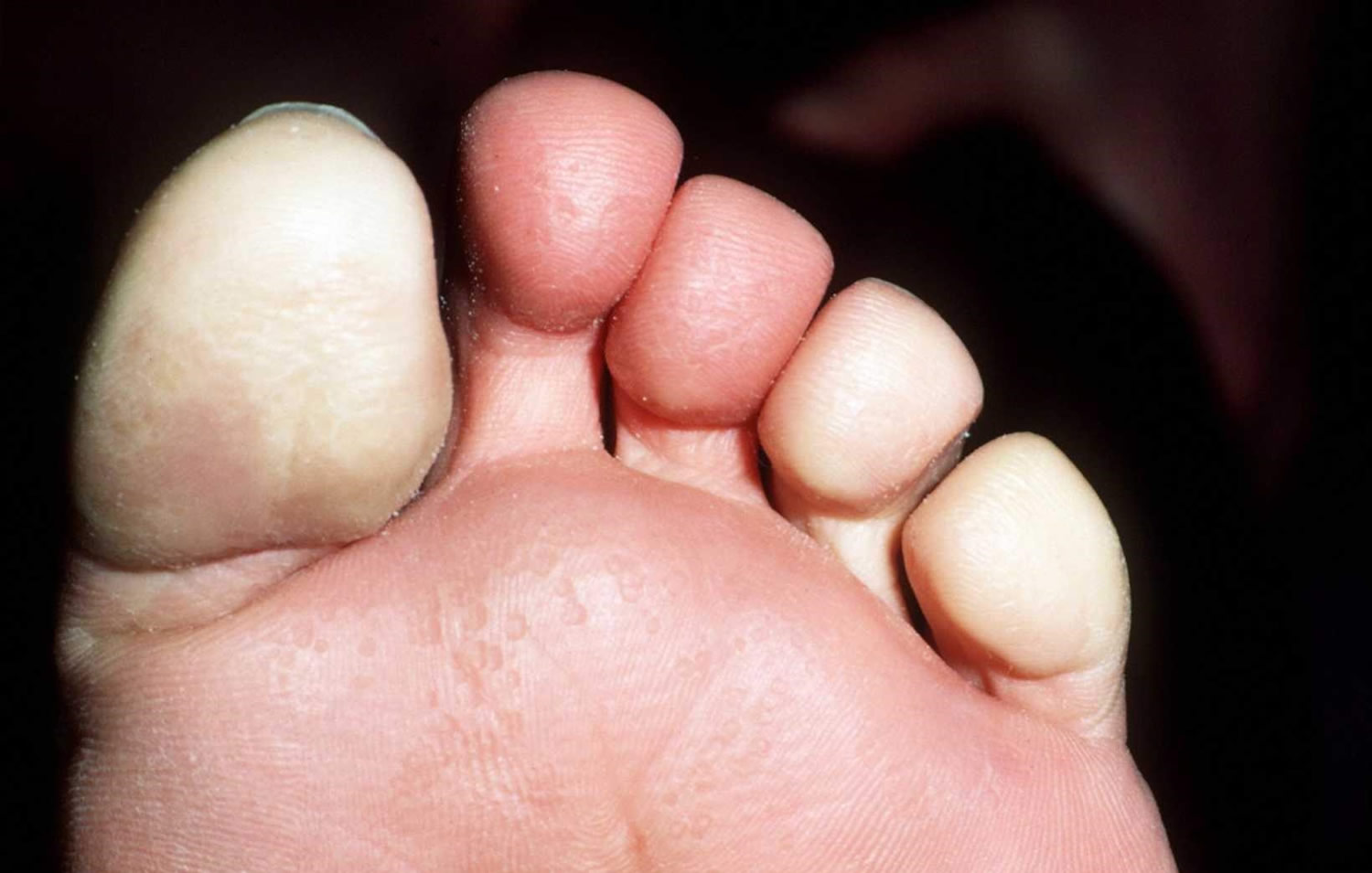 Raynaud's disease foot