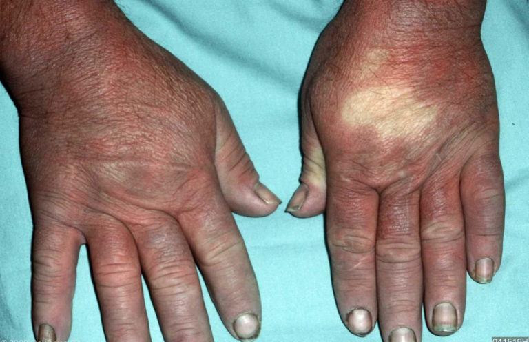 Raynaud's Disease - Causes, Symptoms, Treatment