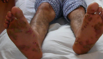 Reactive arthritis rash