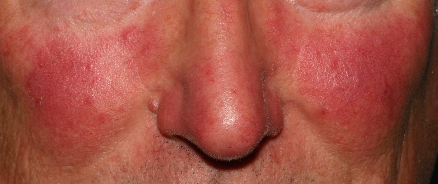 Rosacea Causes Symptoms Cream Diet And Rosacea Treatment