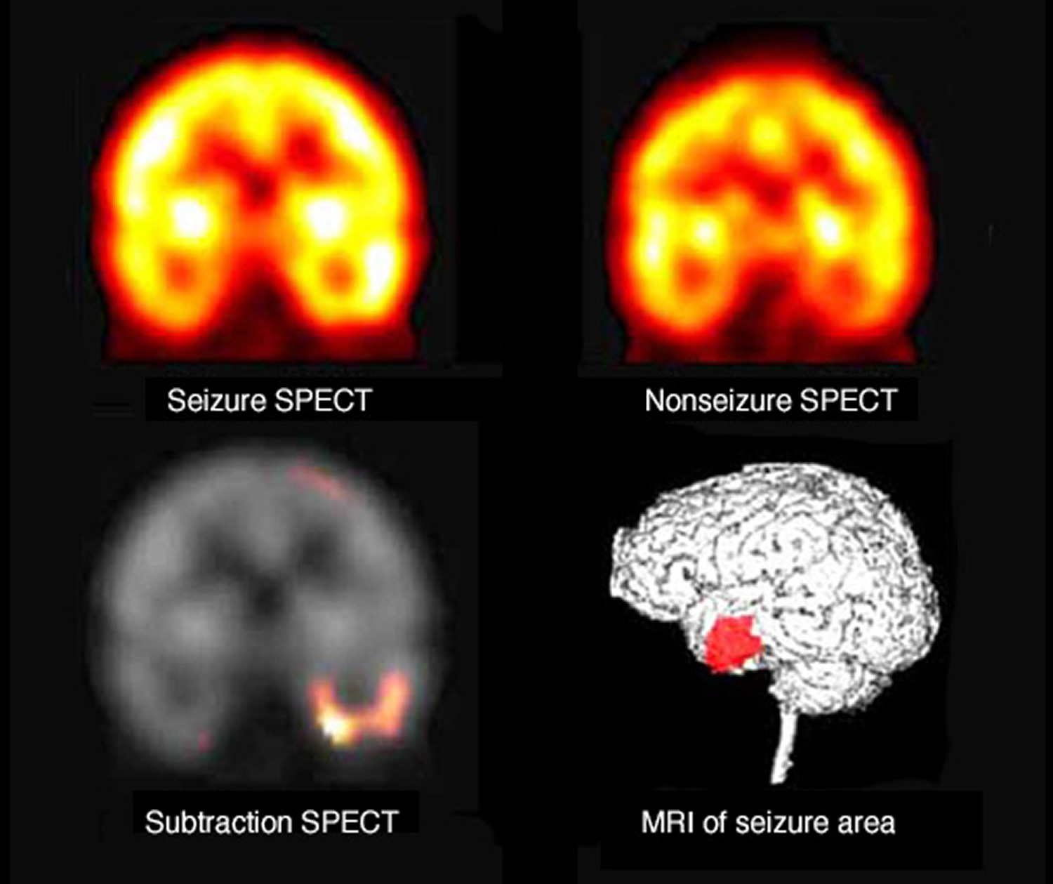 SPECT scans for diagnosing seizures